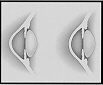 astigmatische (links) und normale (rechts) Hornhaut
